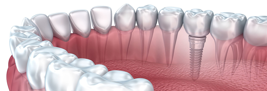 Why-Get-Dental-Implants