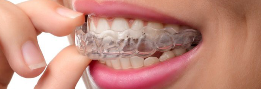 Invisalign Dental Braces Calgary NW