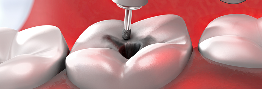 Prevention-of-Cavities-and-Treating-Tooth-Decay