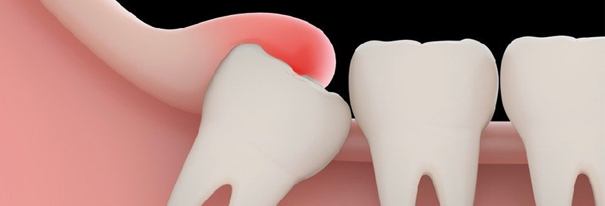 impacted-Wisdom-Teeth