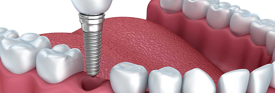 Dental-Implants