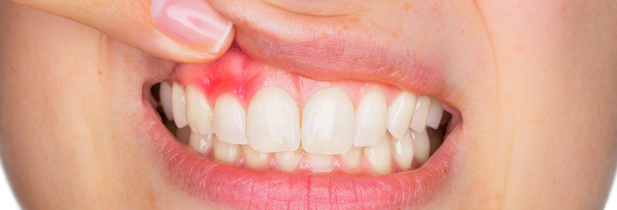Three Symptoms That You May Have Gingivitis