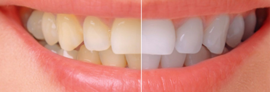 Different-Types-of-Tooth-Discoloration-and-Their-Treatment