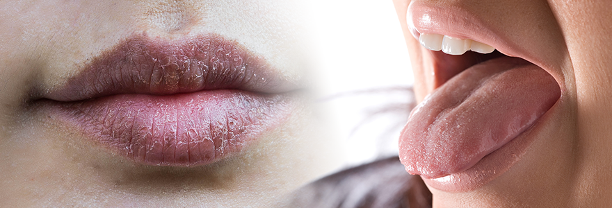 Dry-Mouth-Shouldn't-Be-Ignored
