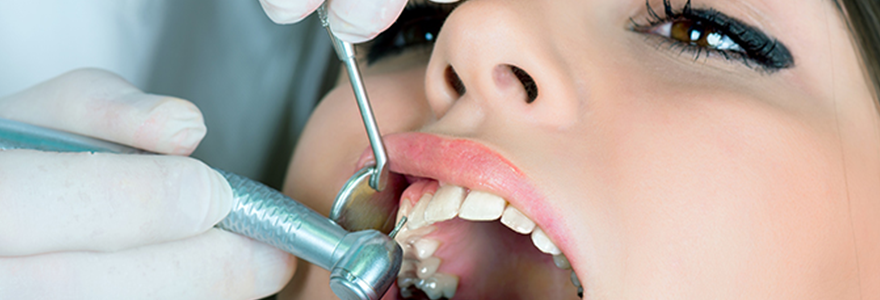 How to Know You Need Dental Fillings