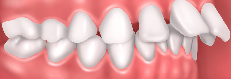 Reasons You Have Misaligned Teeth