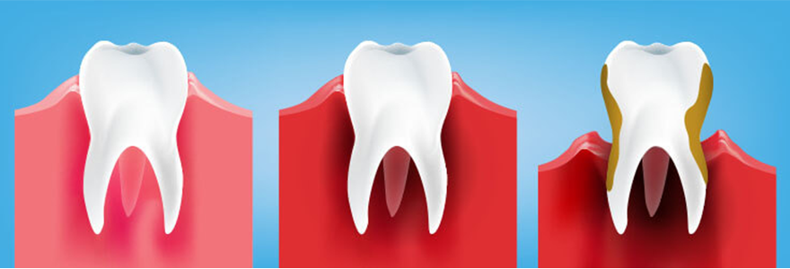 What-is-Gum-Disease