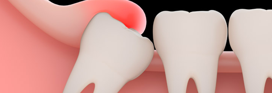Why-Wisdom-Teeth-Are-Removed