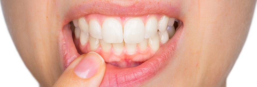 Soothe-Sore-Gums