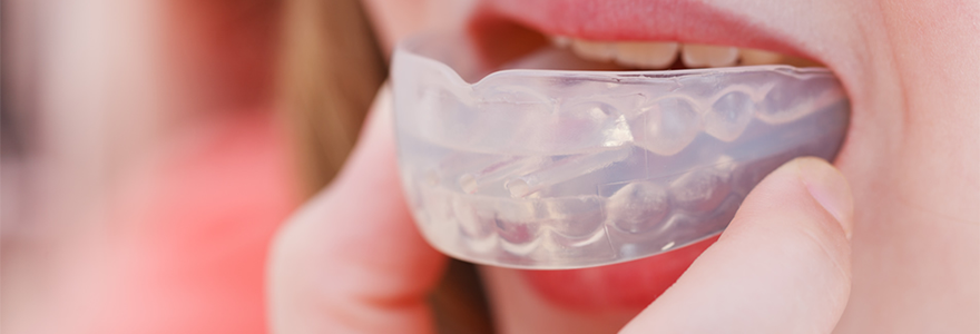 Mouth Guards In Calgary
