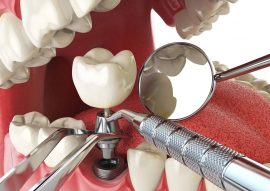 Dental Implants Calgary NW