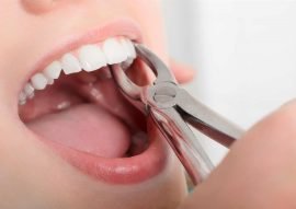 Tooth Extraction Calgary NW