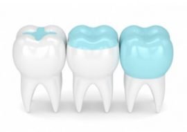 Fillings Inlays And Onlays Calgary NW