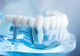 Dental Implants in Calgary NW