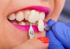 Dental Veneers Calgary NW