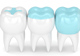 Fillings Inlays And Onlays Calgary NW