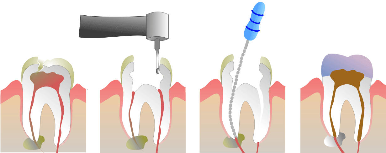 Root Canal Calgary NW