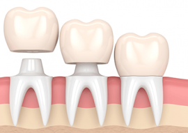 Dental Bridge in Calgary NW