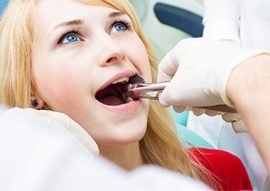 Wisdom Teeth Removal Calgary NW