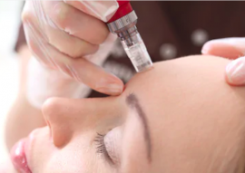 Microneedling Calgary