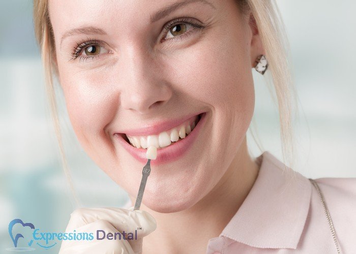 Some Essential Things You Might Not Know About Dental Veneers